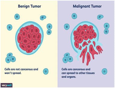 a diagram of the different types of tumors