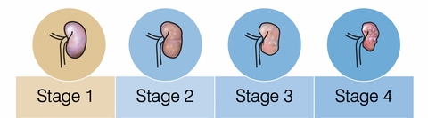 a diagram of stages of the kidney